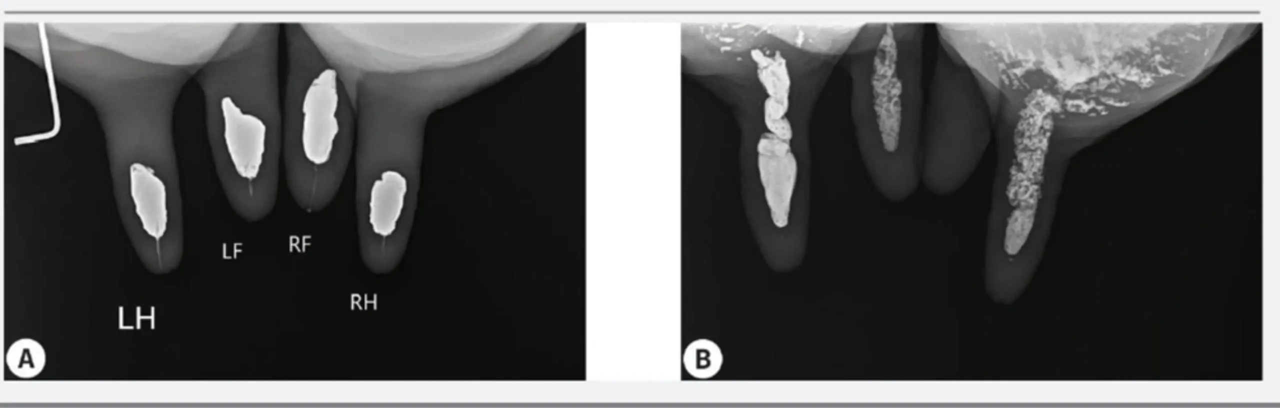 I Sigillanti A Base Di Bismuto Presenti In Commercio